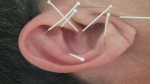 Bild: Chinesische Ohr- Akupunktur